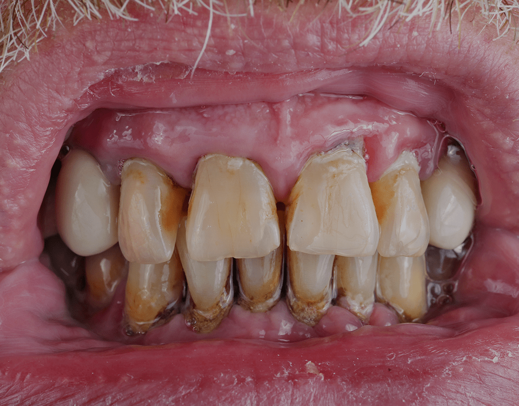 Black Tartar On Teeth Causes Removal Tips And More NatruSmile