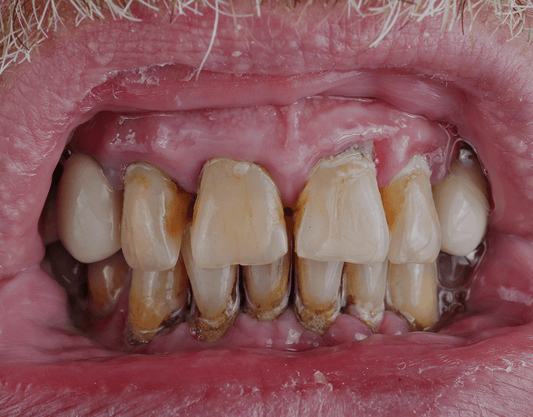 Black Tartar on Teeth: Causes, Removal Tips, and More