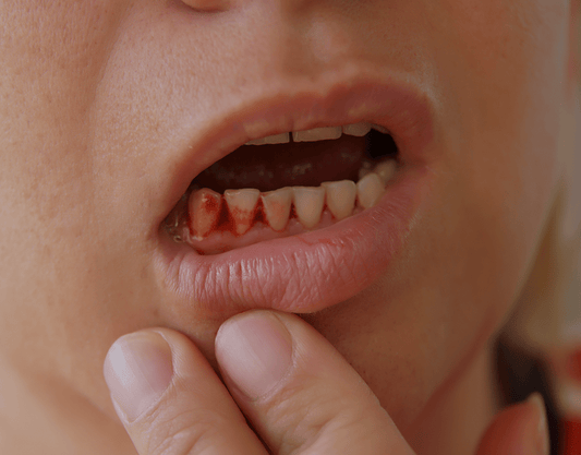 Bleeding Gums: Causes and Treatment Options