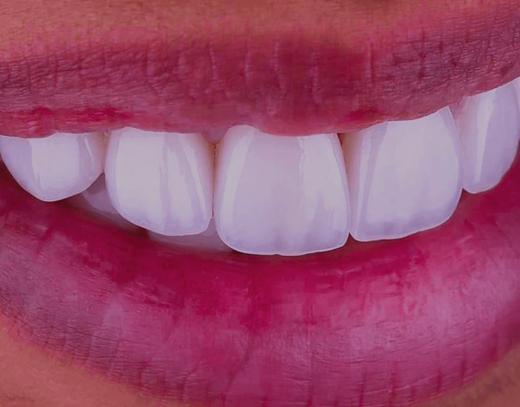 Can You Whiten Veneers? Explained (2023 Guide) NatruSmile