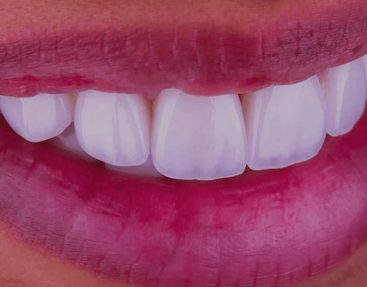 Can You Whiten Veneers? Explained