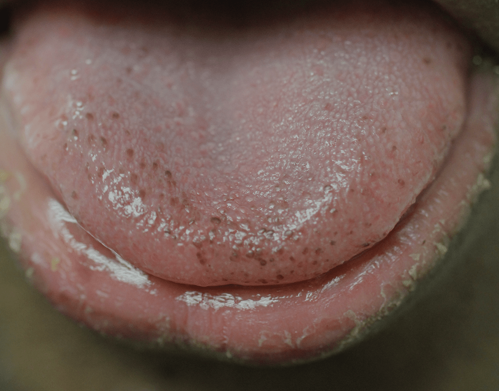 melanotic tongue Oral pigmentation in children: a diagnostic challenge main image 1