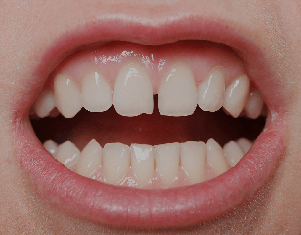 How To Fix Gap Teeth: The Best Solutions For 2023 – NatruSmile