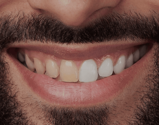 Ways to Get Rid of Yellow Teeth