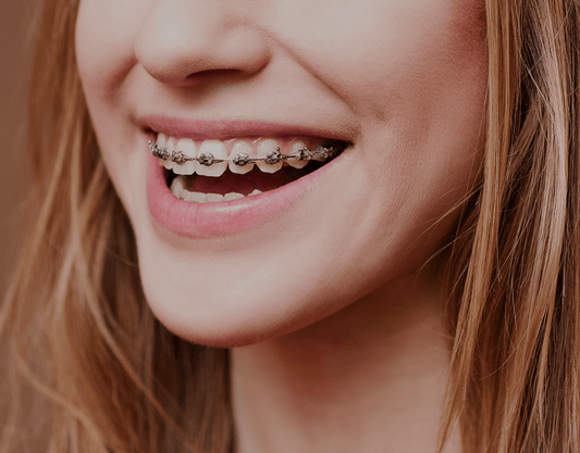 Metal Braces: Uses, Cost, and Comparisons