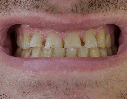 Tooth Discoloration and Stains: Causes and Prevention