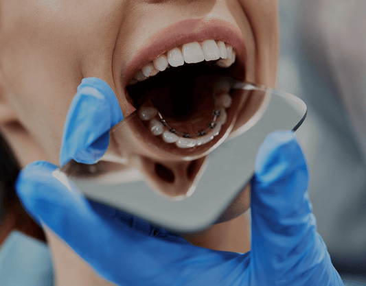 Lingual Braces: Costs, Benefits, and More