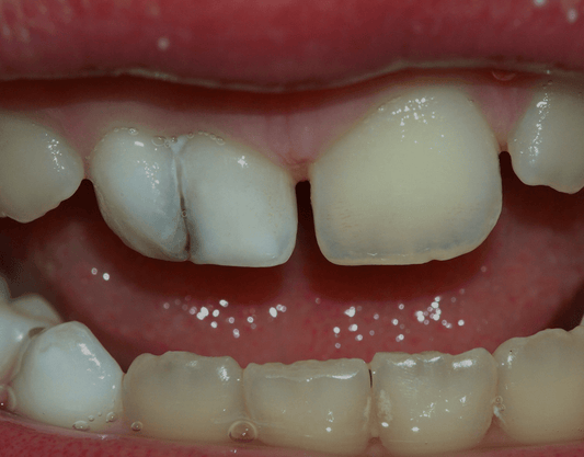 Tooth Gemination Causes and Treatments