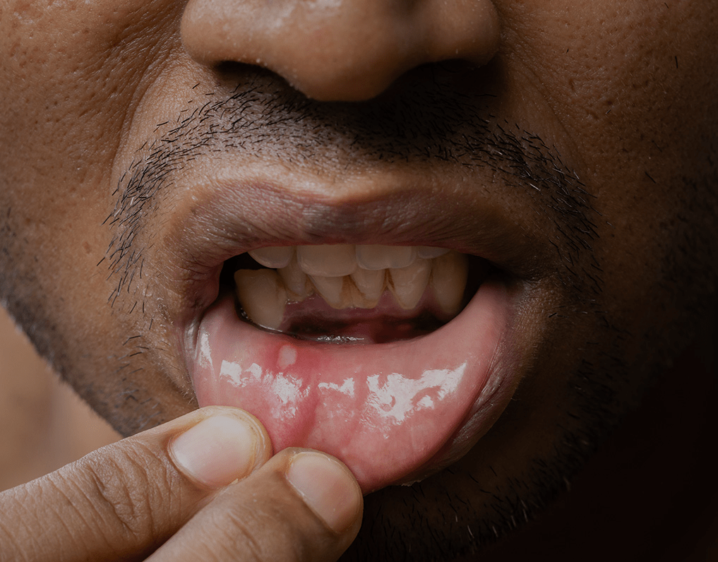 White Spots On Gums Causes, Treatment And Prevention NatruSmile