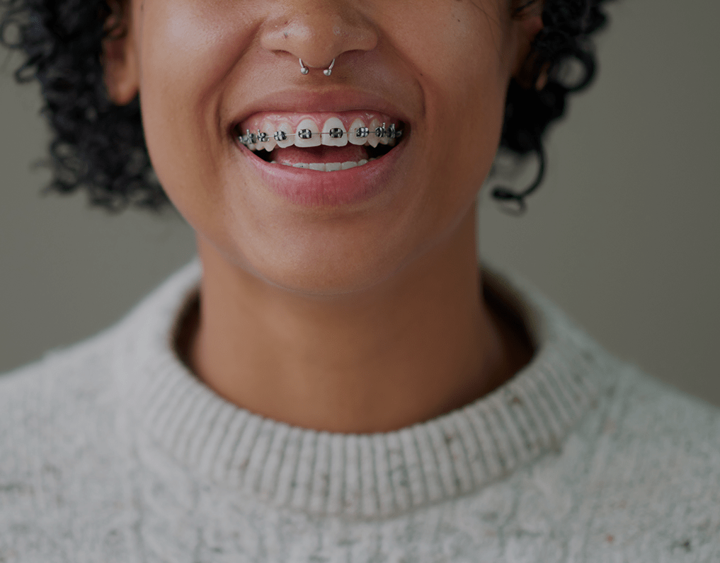 White Colored Braces How To Choose The Color Of Your Braces: 14 Steps