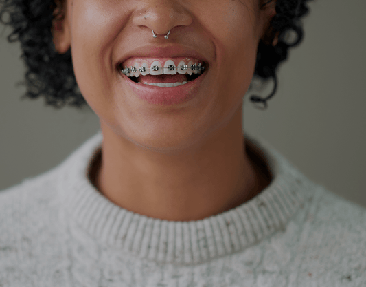 Best Braces Colors to Make Your Teeth Look White