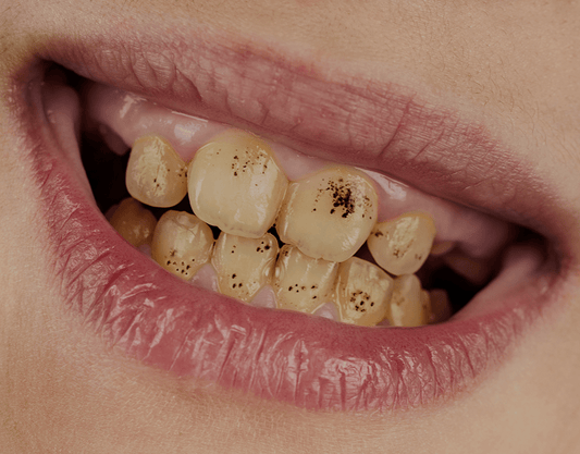 Black Dot on Tooth: Causes, Treatment Options, and More