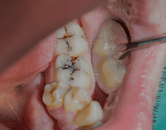 Black Lines on Teeth: Causes, Treatment Options, and More