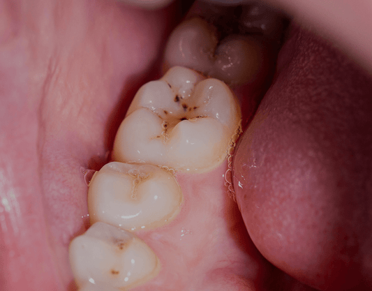 Black Stains on Teeth: Causes, Treatment Options, and More