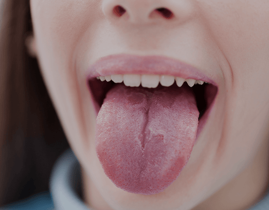 Burned Tongue: Causes, Risk Factors, and Symptoms