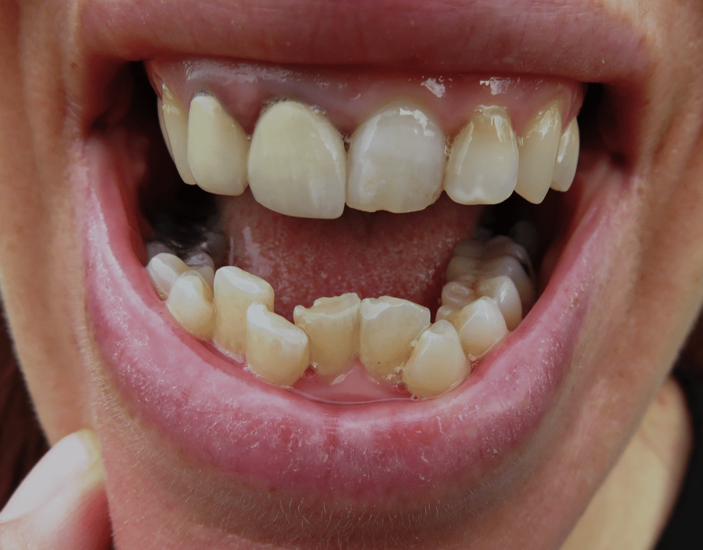 Can You Get Veneers With Crooked Teeth? (2023) NatruSmile