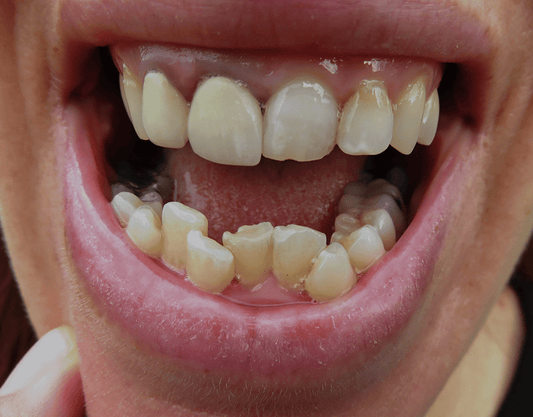 Can You Get Veneers With Crooked Teeth?