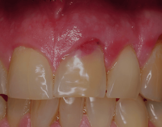 Resorption of Teeth: Causes, Symptoms, and More