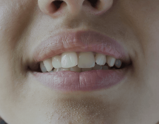 Causes of Crooked Teeth (and How to Straighten Them)
