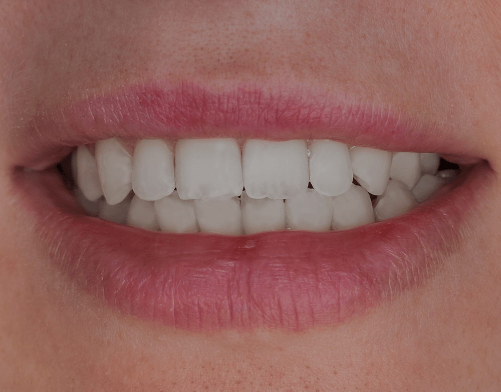 Translucent Teeth Learn The Causes And Fixes NatruSmile