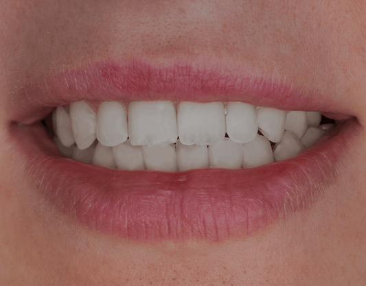 Translucent Teeth: Learn the Causes and Fixes