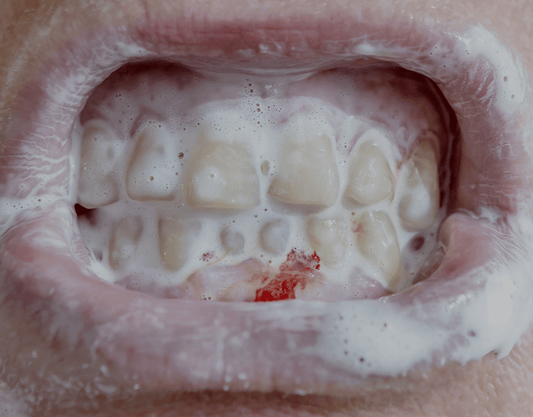 Cut On Gums: Causes, Treatment & Prevention