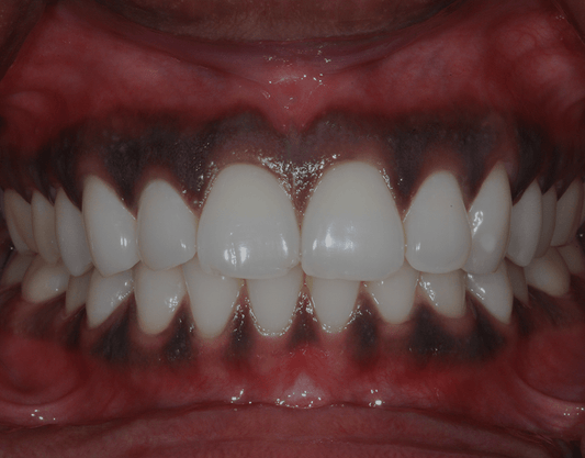 Dark or Black Gums: Causes and Symptoms