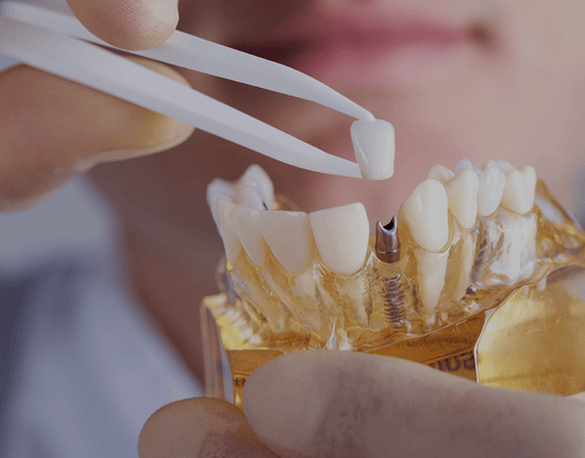 Dental Crown Vs. Dental Bridge