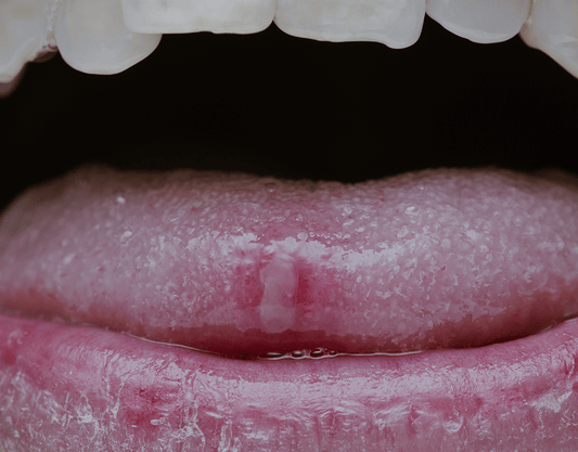 Herpes on the Tongue: Symptoms, Causes, and Treatment Options