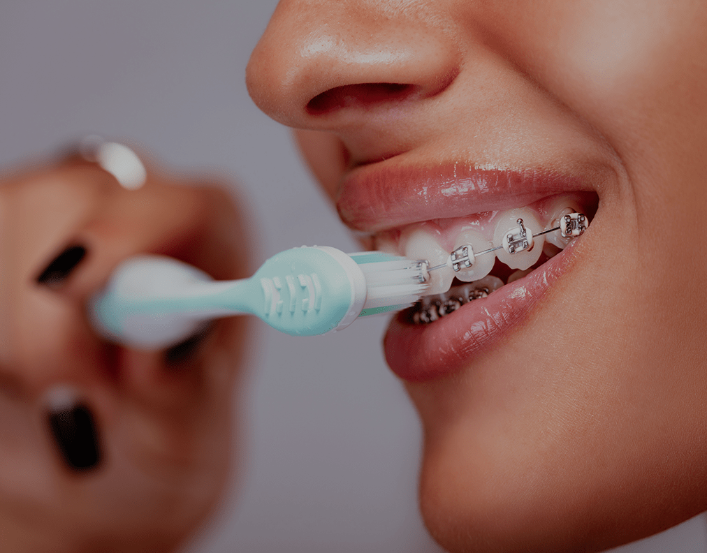 How To Clean Teeth With Braces 2023 Guide NatruSmile how-to-clean-teeth-with-braces-2023-guide-natrusmile