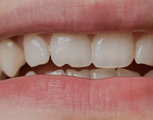 Chipped Tooth: Causes, Treatment, and Recover