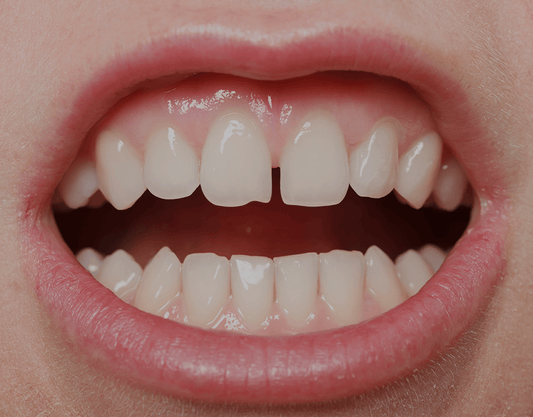 How To Fix Gap Teeth: Best Solutions For 2023
