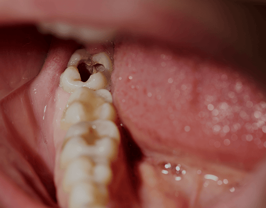 How to Get Rid of Cavities