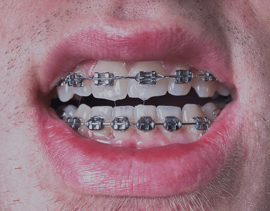 How To Get Rid Of Yellow Teeth With Braces: Steps To A Brighter Smile