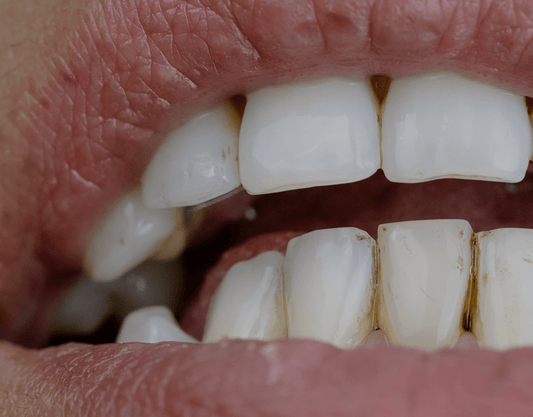 How to Remove Brown Stains from Teeth Naturally