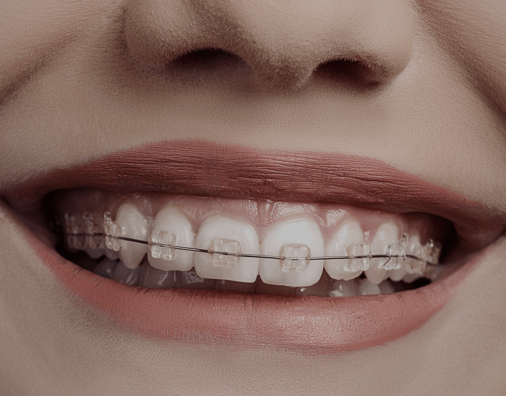 5 Effective Ways To Whiten Teeth With Braces (2023 Guide) NatruSmile