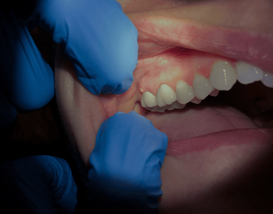 Infection After Tooth Extraction: Everything You Need to Know