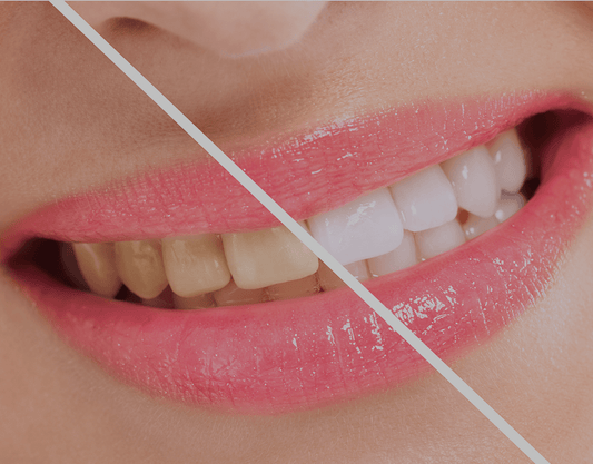 Is It Possible To Whiten Yellow Teeth