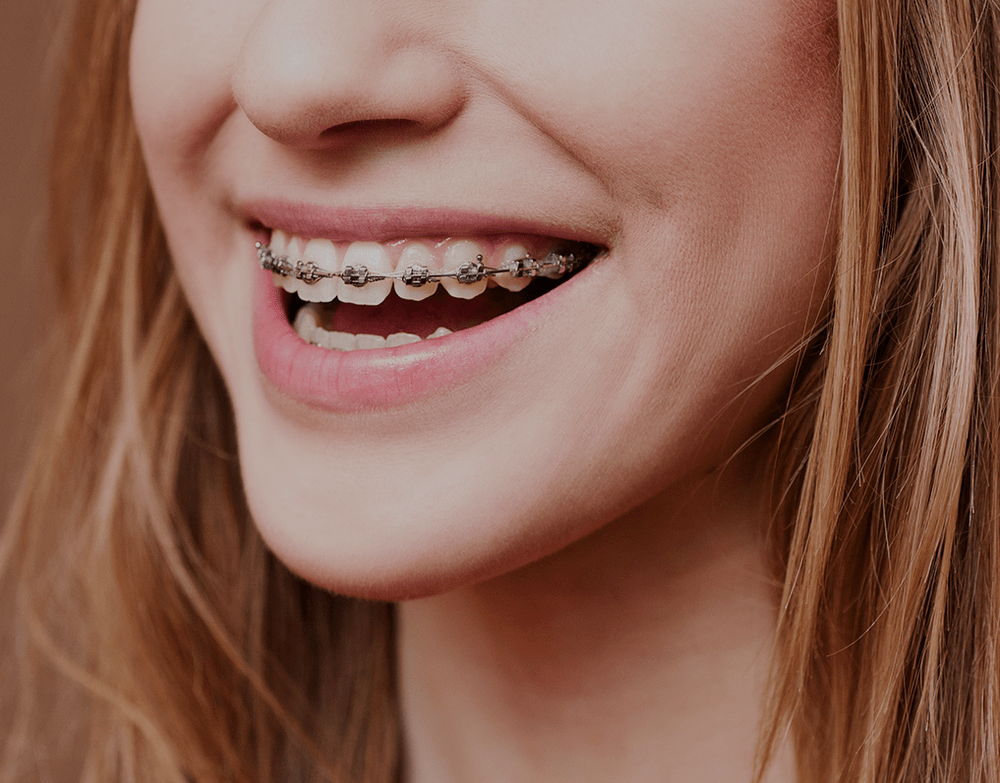 Metal Braces Uses, Cost, And Comparisons (2023 Guide) NatruSmile