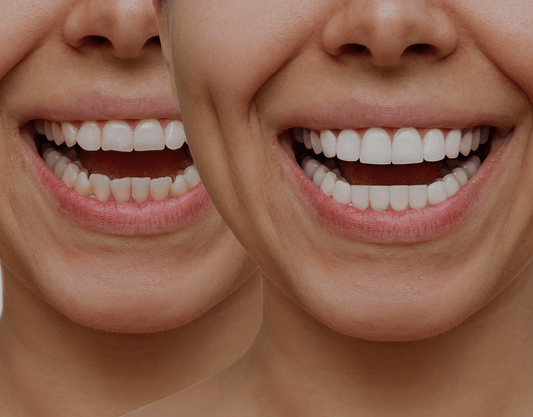 Porcelain vs. Composite Veneers: Which is Best?