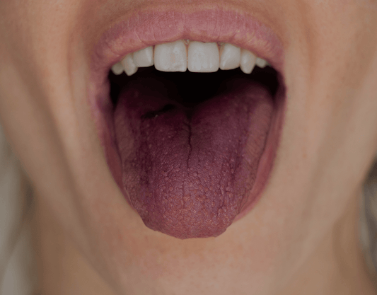 Purple Tongue: Causes and Treatment Options