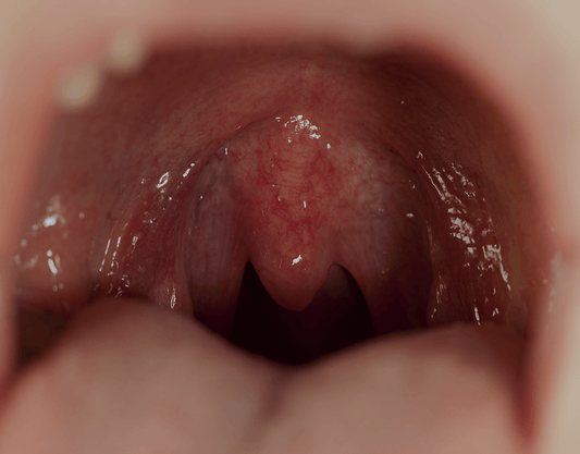 Red Spots On The Roof Of Your Mouth