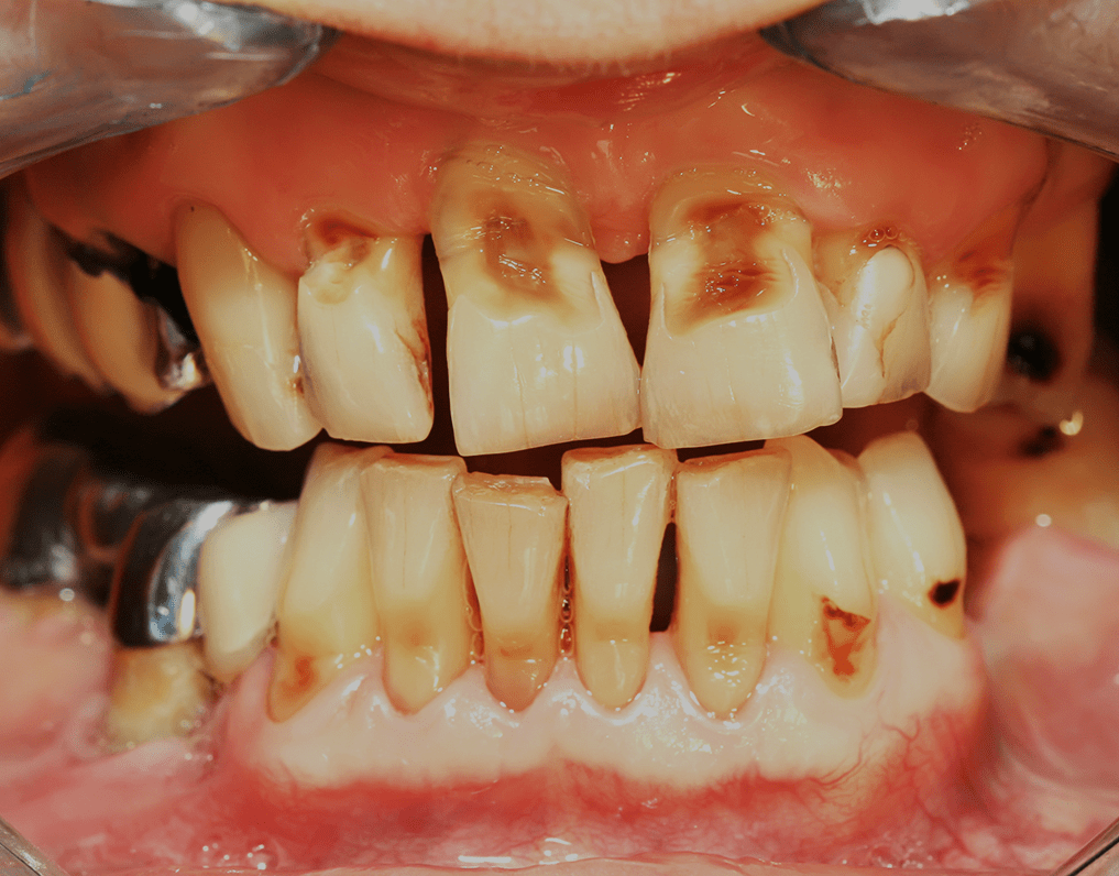 Rotten Teeth: Symptoms And Treatment (2023 Guide) – NatruSmile