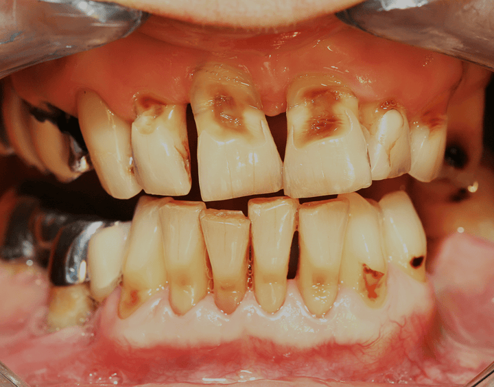 Missing Teeth Rotten Rotten Teeth: Symptoms And Treatment (2023 Guide) – NatruSmile
