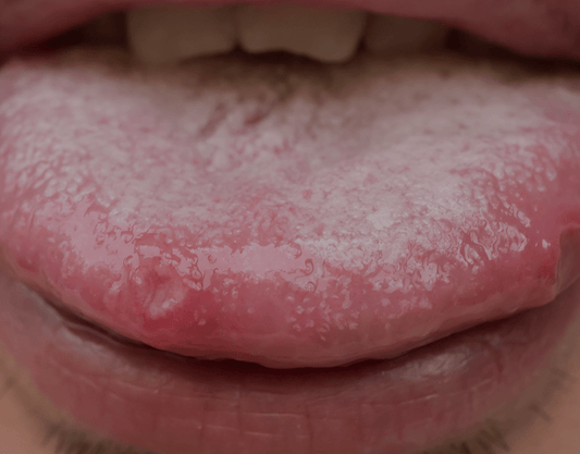 Spots On Your Tongue: Symptoms, Causes, Treatment & Prevention