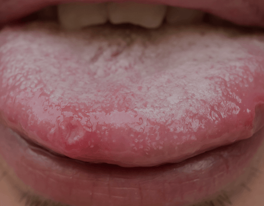 Tongue tip hot sale sore