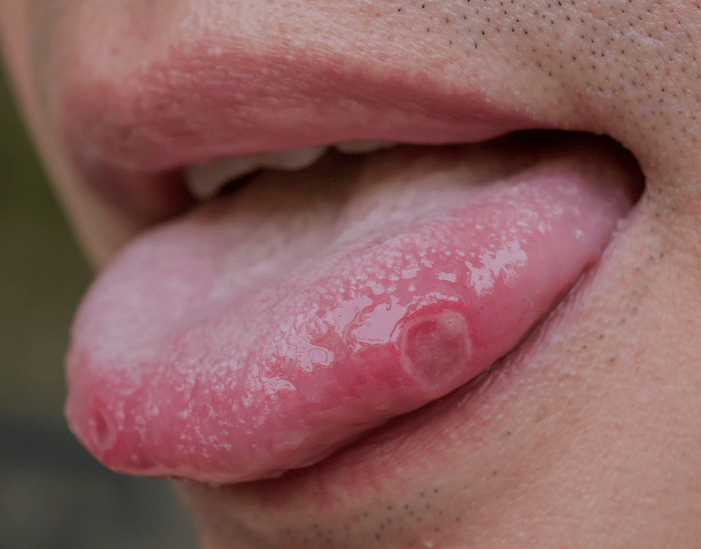 Tongue Ulcers: Symptoms, Causes, And Treatment – NatruSmile