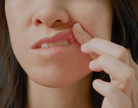 Canker Sores: Treatments, Causes, and Symptoms