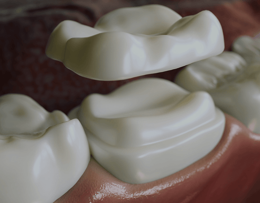 Dental Crowns: Types, Procedure & Care