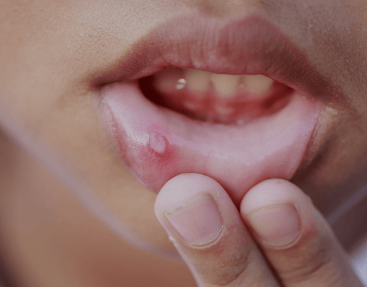 Mouth Sores: Symptoms, Treatment, and Prevention Methods